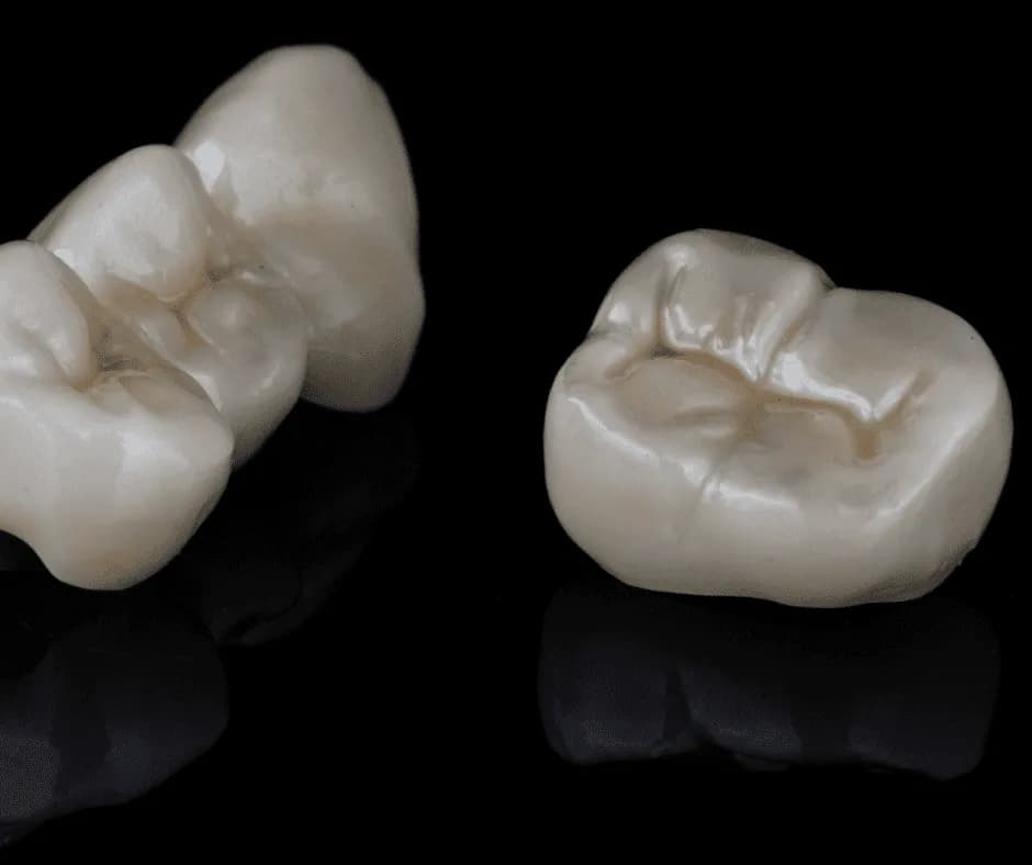 Carillas y coronas dentales