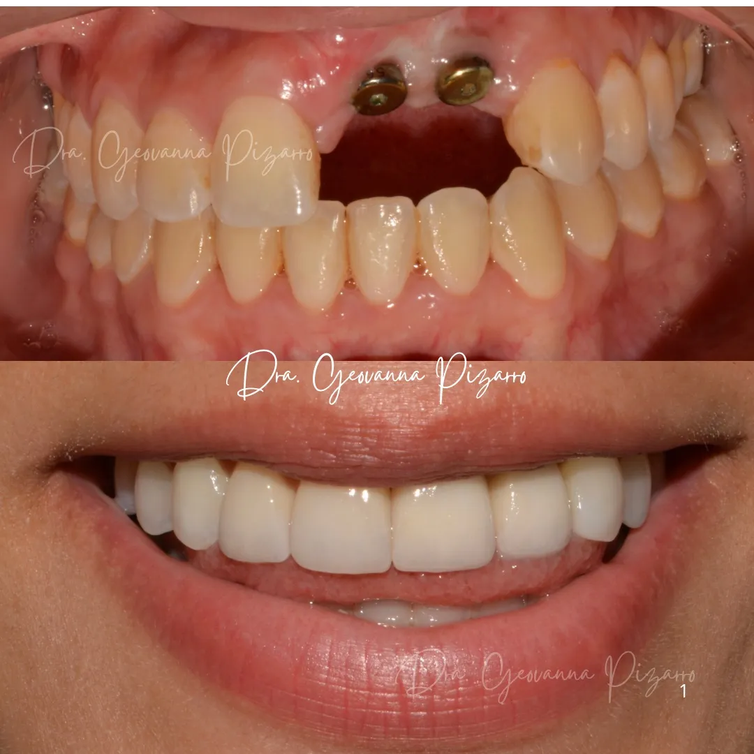 Carillas Dentales Paso a Paso - Procedimiento detallado en Lima