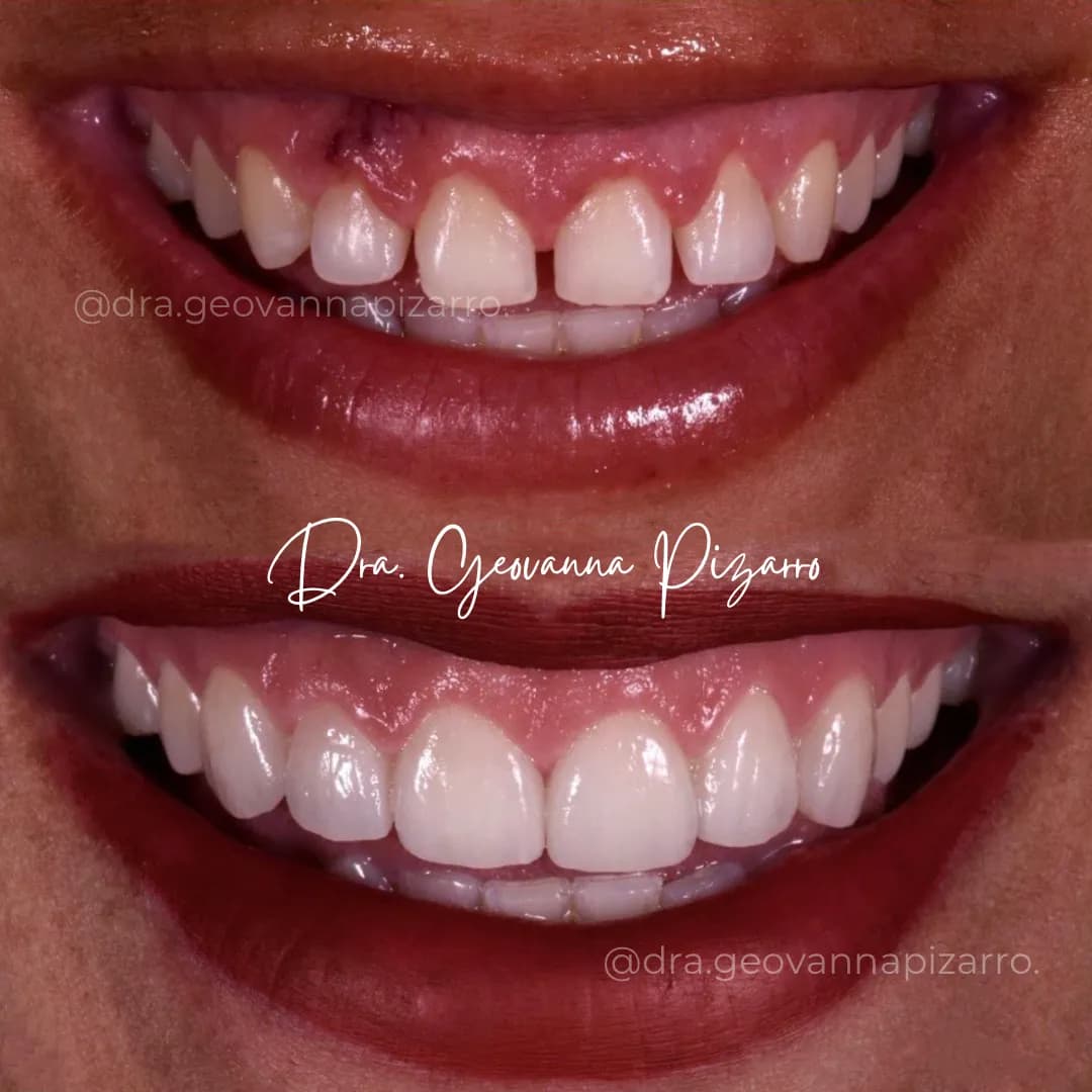 Ortodoncia Invisible vs Carillas Dentales en Surco, Lima - ¿Qué te conviene?