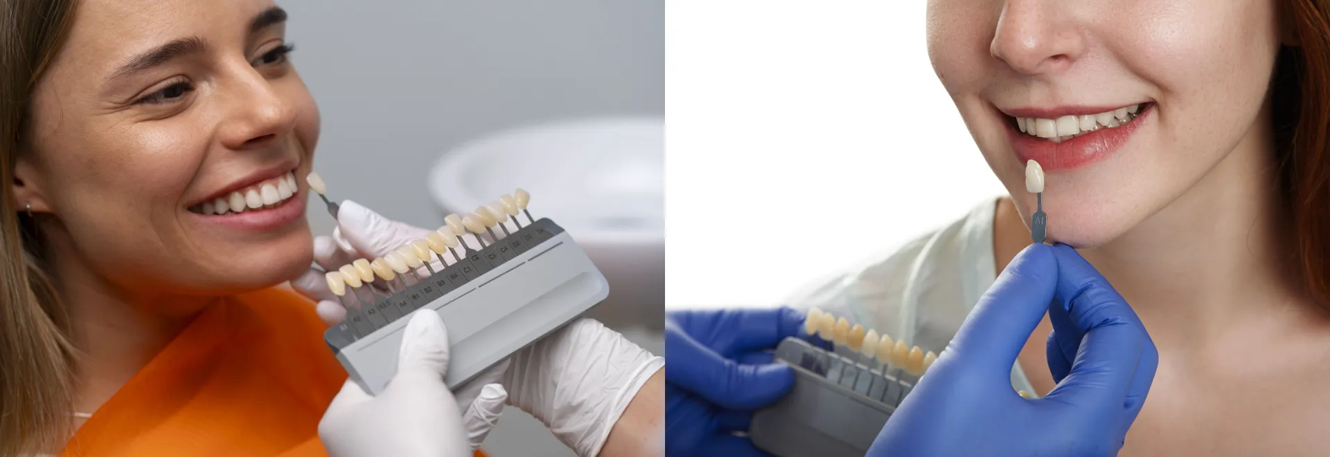 Precios de Carillas Dentales 2025 en Surco, Lima - Porcelana vs Resina