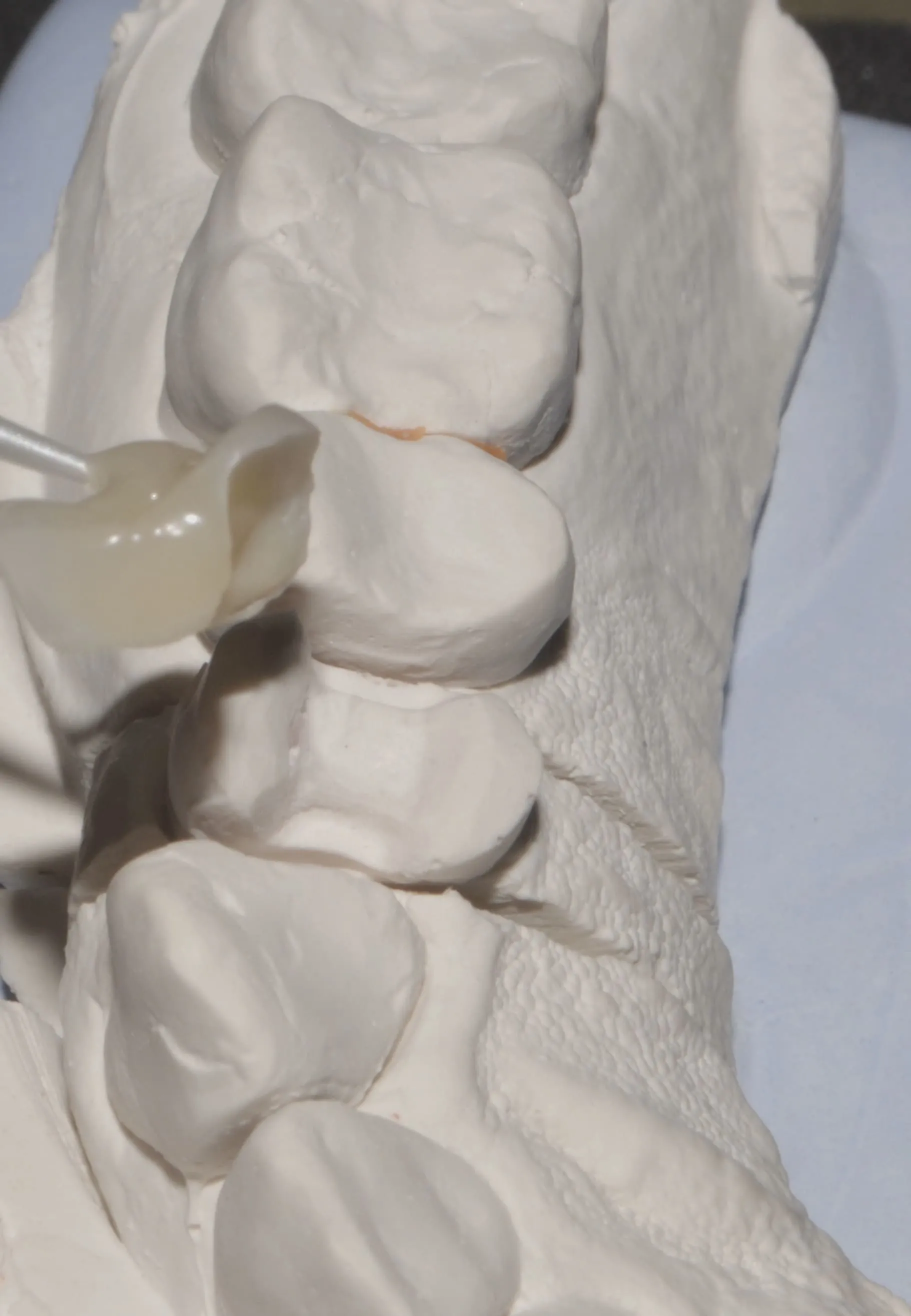 Incrustaciones dentales